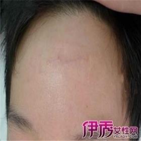 脸上的疤痕会影响自己的命运吗?脸上有疤痕面相分析
